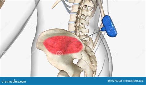 Bone Marrow Biopsy, External View Stock Illustration - Illustration of ...