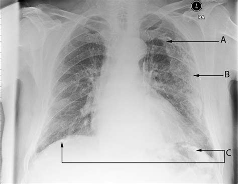 An overview of how asbestos exposure affects the lung | The BMJ