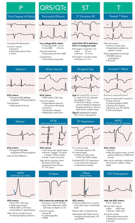 Ecg Abnormalities Chart: Understanding The Signs And Symptoms - Dona