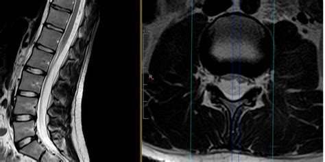 Tethered Cord Evaluation - Dr. Gilete