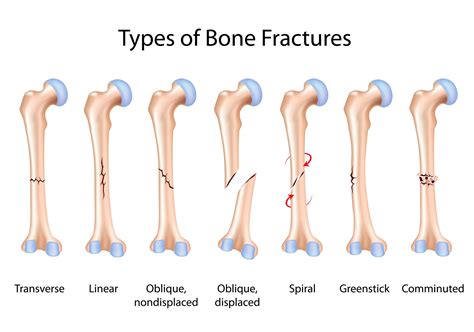 Types of Broken Bones: Symptoms, Treatment, Healing - Hernando ...