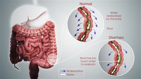 [DIAGRAM] Diagram Of Diarrhea - MYDIAGRAM.ONLINE