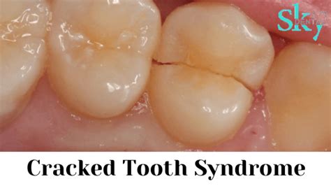 Cracked Tooth Syndrome - Symptoms, causes, Diagnosis & Treatment