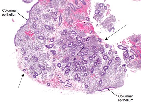 Normal Endometrium Histology