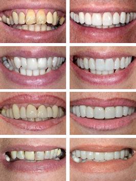 Dental Crown Procedure and Fitting | The Perfect Smile