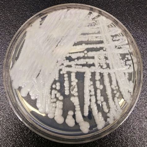 CDC warns of ‘alarming’ spread of deadly fungus across U.S. | AllSides