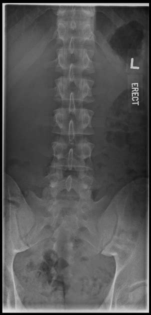 Ap Lumbar Spine Xray