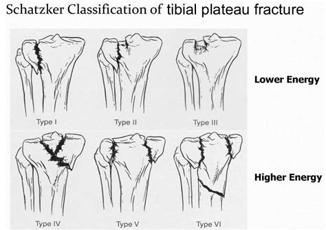 Tibial Plateau Fracture Classification And Treatment | Porn Sex Picture