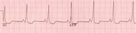 WPW in normal sinus rhythm with a short PR interval and classic “delta ...