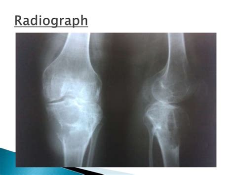 Osteosarcoma Radiology Review