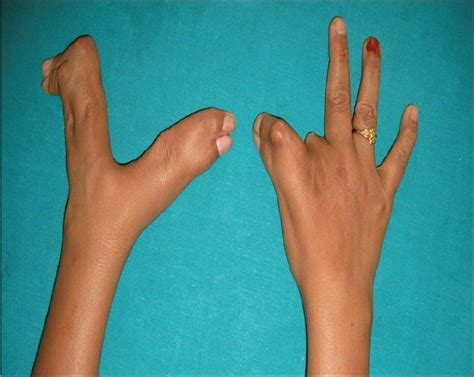 Congenital Deformities of the Hand