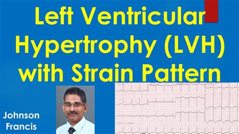 Left Ventricular Hypertrophy LVH with Strain Pattern on ECG - YouTube