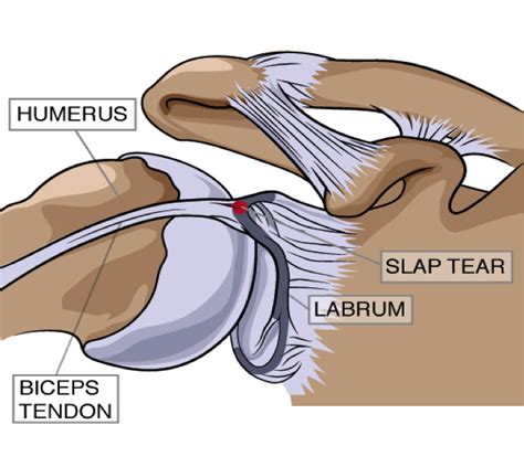 Condition of the Month - SLAP Tear The term “SLAP” stands for Superior ...