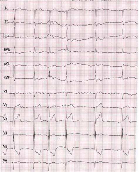 ECG showing atrial fibrillation and LVH and a gross increase in ...