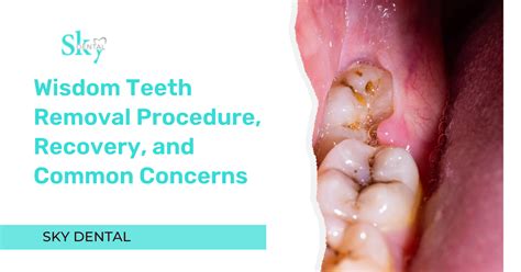 Wisdom Teeth Removal Procedure, Recovery, and Common Concerns