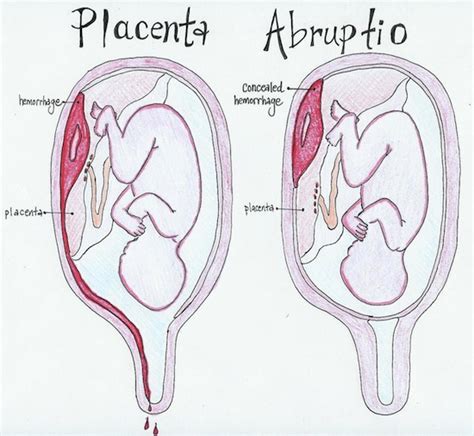 Placental Abruption