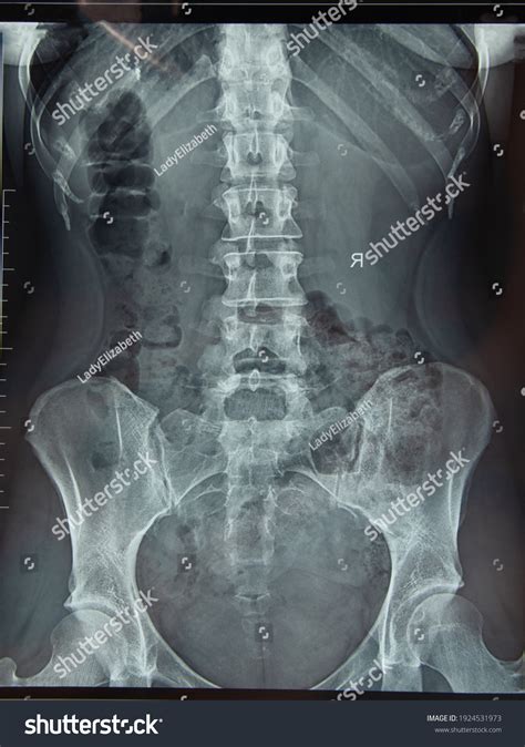 45,707 X Ray Spine Images, Stock Photos & Vectors | Shutterstock