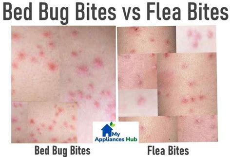 Bed Bug Bites vs Flea Bites: How to Tell the Difference and Get Relief ...