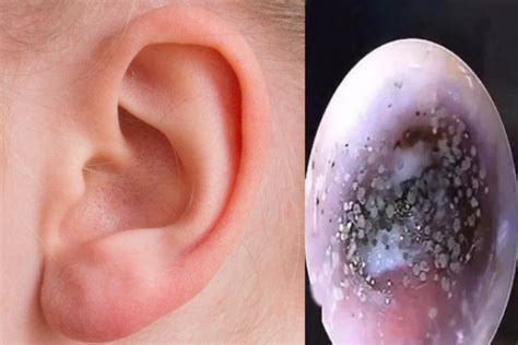 'Mould' found growing in boy's ear canal, said to be due to wearing ...