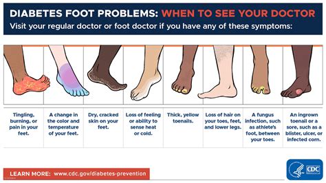 Diabetic Foot