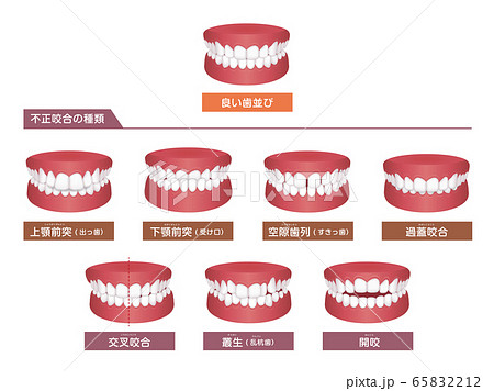 歯並び・歯列・不正咬合の種類 ベクターイラストセット 65832212