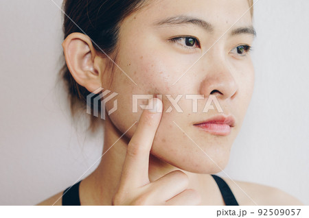 Portrait of Asian woman has problems with skin on her face. Conceptual shot of problems with acne and scar on the female skin. 92509057