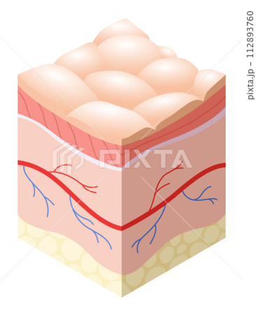 Skincare medical concept. Problems in cross-section of human skin horizontal layers structure. Anatomy illustrative model unhealthy layer of skin 112893760