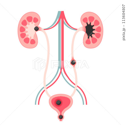 尿路結石の種類 ベクターイラスト (文字なし) 113684807
