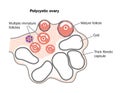 Polycystic ovary