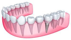 Implant Teeth