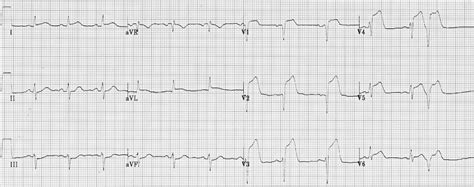 Anterior Myocardial Infarction • Litfl • Ecg Library Diagnosis