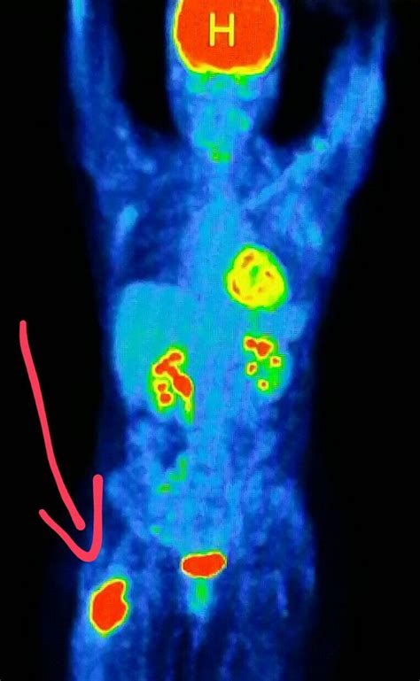 The Best Pet Scan Radiation 2023