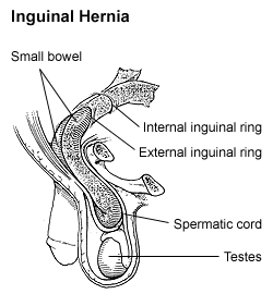 Diagram of an indirect, scrotal inguinal hernia (median view from the left).