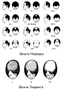 Градації андрогенетичної алопеції