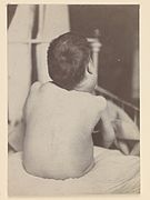 Boy affected by large lymphadenomatous growths Wellcome L0062839.jpg