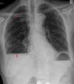 Sero- oder Hämatopneumothorax