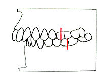 Angle-Klasse II/1