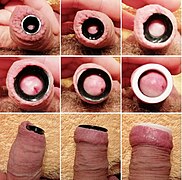 Stretching of foreskin to cure phimosis using silicon ear plugs.jpg