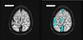 Axiales SWI-Bild der scheitelnahen Duravenen. Die Thrombose ist im rechten Bild blau hervorgehoben.