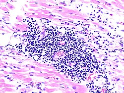 Egy myocarditis kórszövettani képe egy akut pangásos szívelégtelenségben elhunyt páciensből.