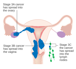 Cancro do endométrio em estágio III