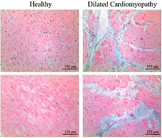 Healthy myocardium versus interstitial fibrosis in dilated cardiomyopathy. Alcian blue stain.