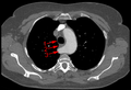 Arteria subclavia aberrante mediante TAC. (1) Tráquea, (2) Esófago, (3) Arteria subclavia aberrante