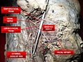 Facial nerve at foetus