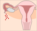 Schematische Darstellung eines Tubaraborts