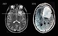 تصوير بالرنين المغناطيسي، يبين تطور الورم النجمي على مدى سبع سنوات.