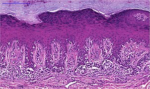 Verlängerte Retezapfen der Epidermis