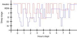 Sleep pattern of a restless legs syndrome patient (red) vs. a healthy sleep pattern (blue).