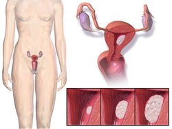 Blausen 0348 EndometrialCancer.png