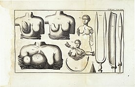 L. Heister, latent or occult breast cancer Wellcome L0023637.jpg